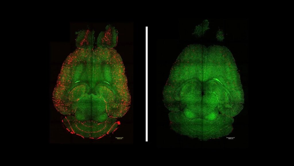 A Nanoparticle Drug Triggered the Brain to Rapidly Flush Out Toxic Alzheimer’s Proteins in Mice A Nanoparticle Drug Triggered the Brain to Rapidly Flush Out Toxic Alzheimer’s Proteins in Mice