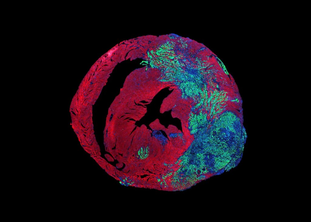 The Heart Rarely Gets Cancer. Scientists Think They Know Why. The Heart Rarely Gets Cancer. Scientists Think They Know Why.