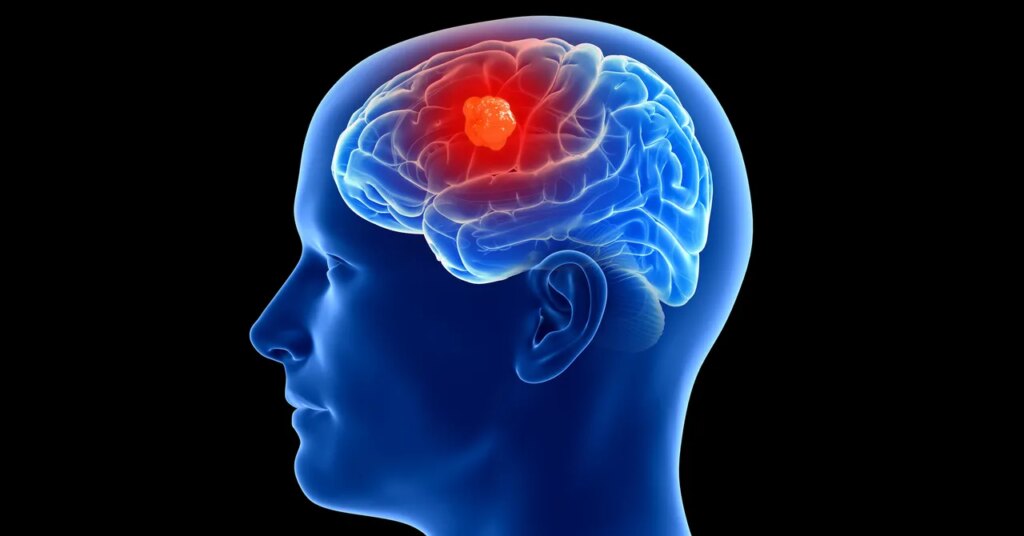 3 People Have Gotten Cancer-Detecting Implants in Their Brains 3 People Have Gotten Cancer-Detecting Implants in Their Brains