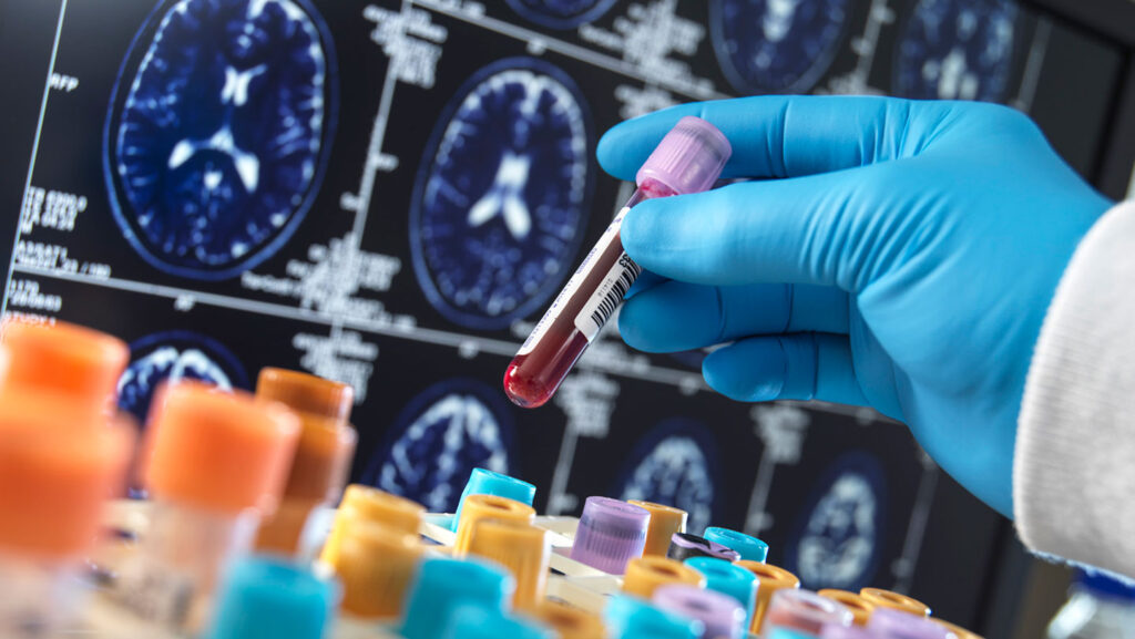 A blood test for dementia may tell you if you have more than one type