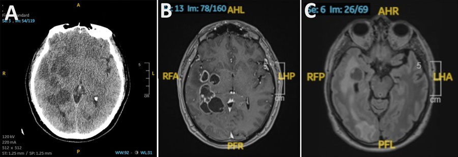 Doctors suspected man had brain cancer. He actually had worms. Doctors suspected man had brain cancer. He actually had worms.