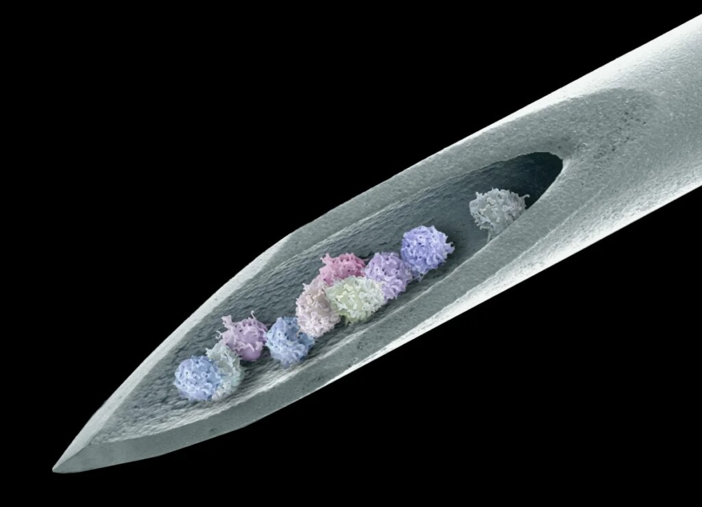 Stem cells banish severe autoimmune disease for 15 years Stem cells banish severe autoimmune disease for 15 years