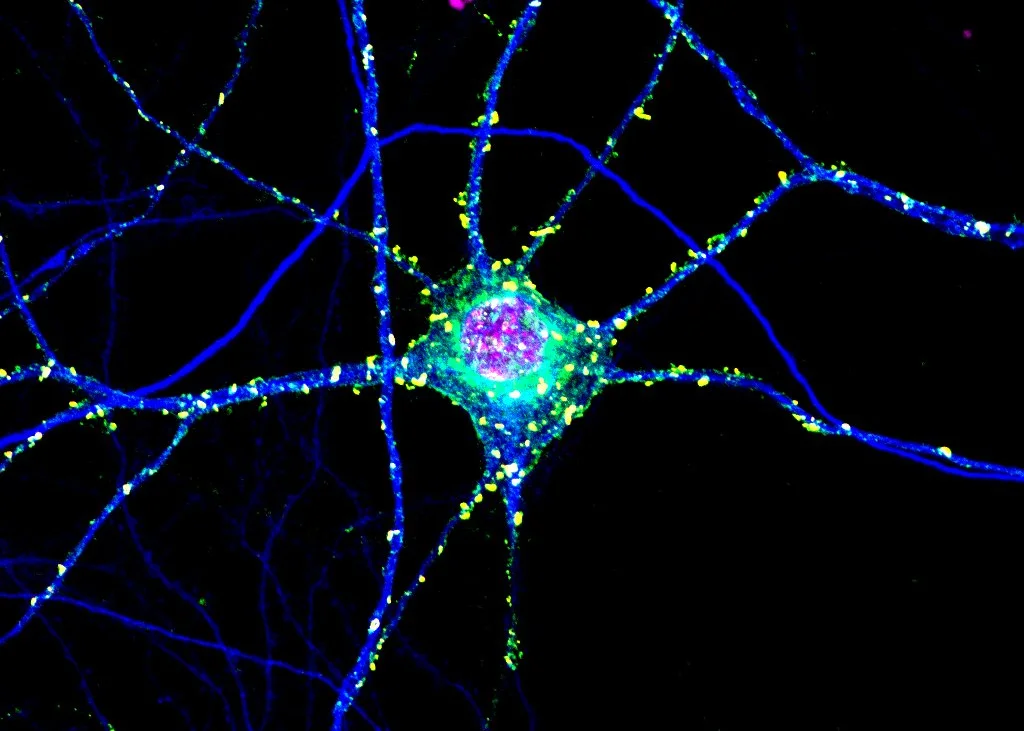 Toxic Clumps in Huntington’s Disease May Protect the Brain Too Toxic Clumps in Huntington’s Disease May Protect the Brain Too
