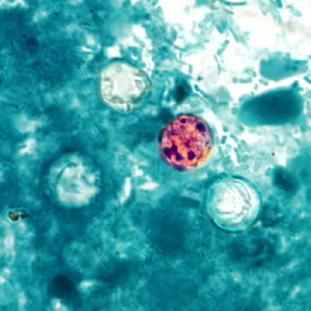 Cases of explosive diarrhea-causing cyclosporiasis are rising fast in the U.S.
